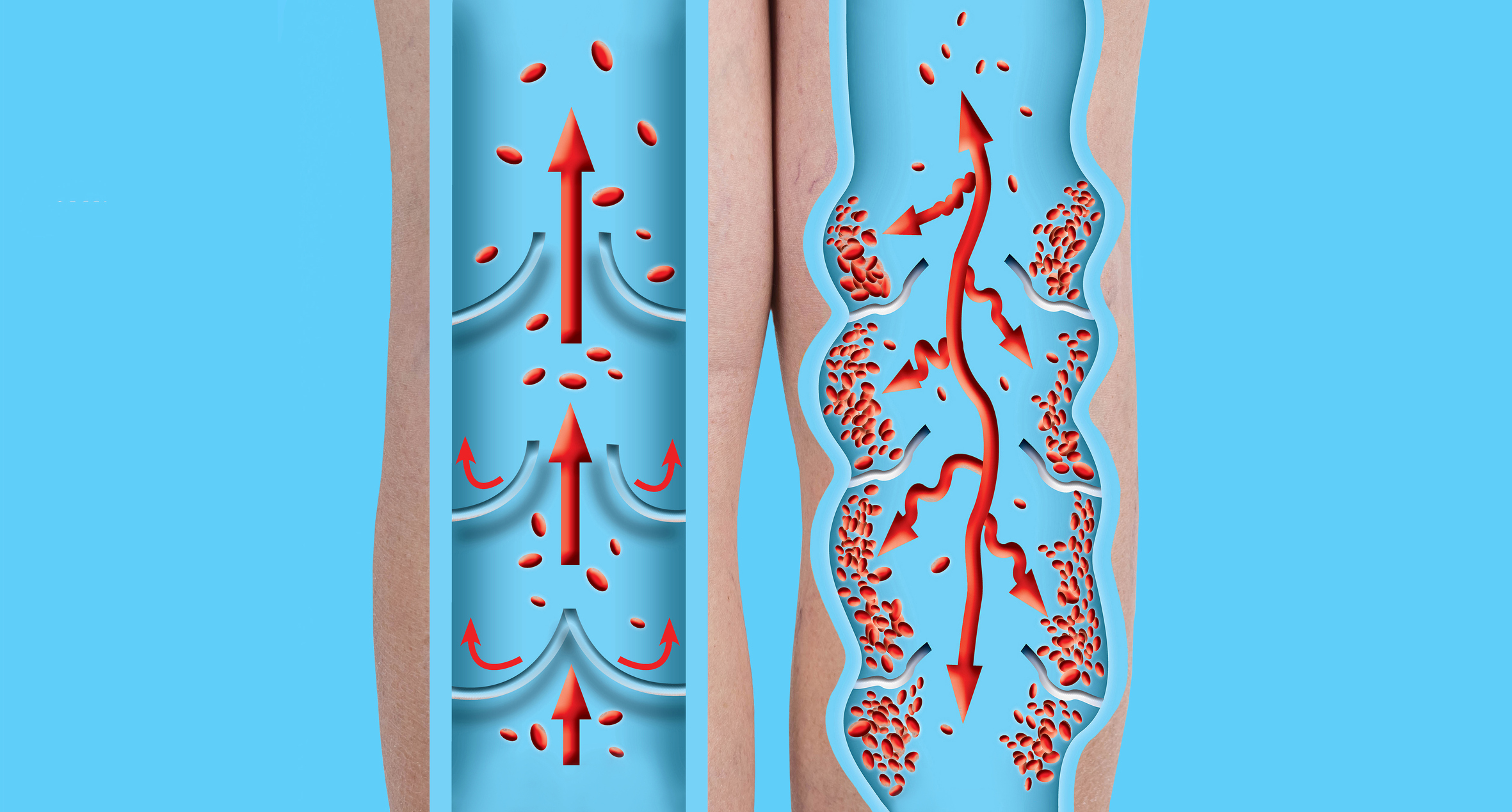 What you should know about peripheral artery disease