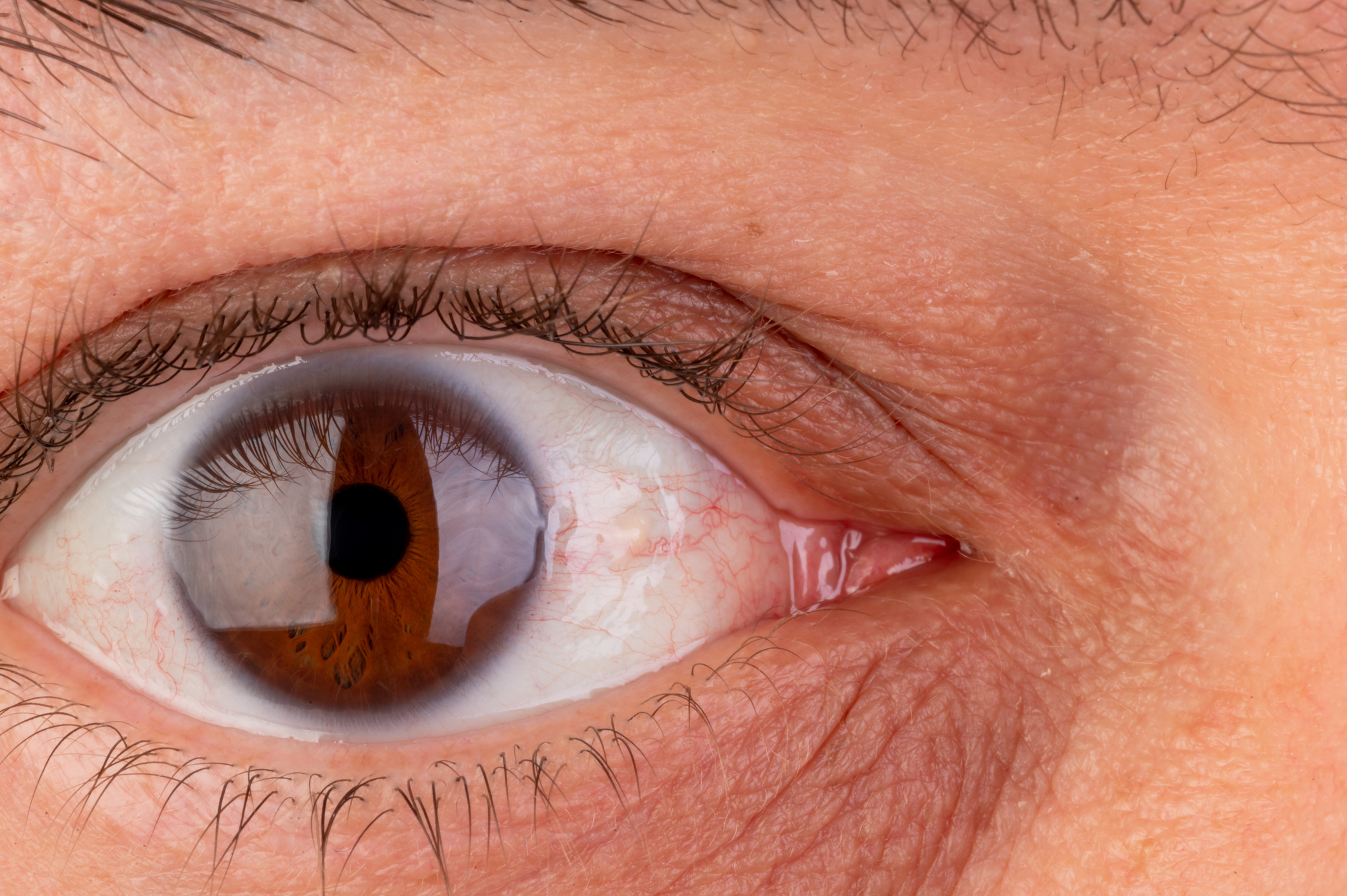 Catching AMD before you start losing vision